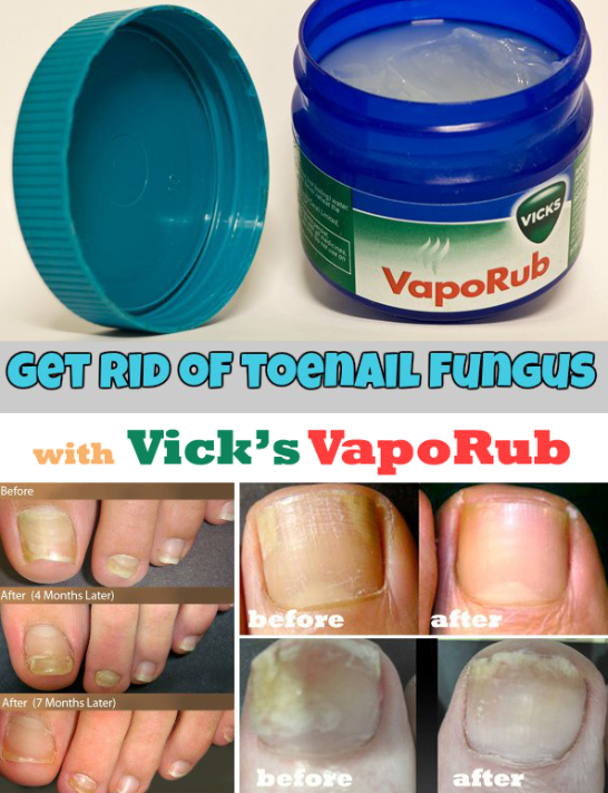 How to cure nail fungus with Vick's Vaporub
